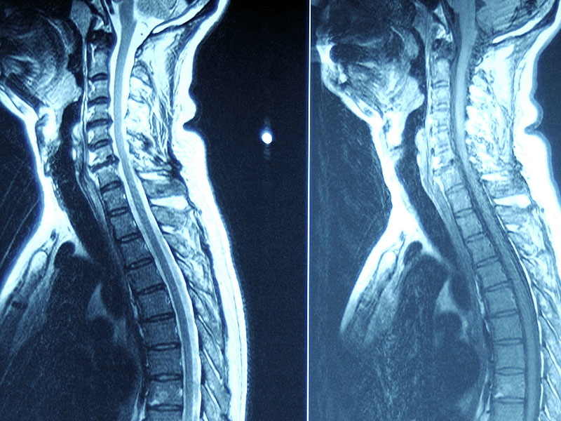 Normal Human Spine X Ray